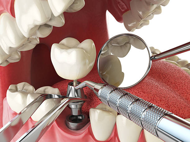 Best Emergency Tooth Extraction in Amador Pines, CA